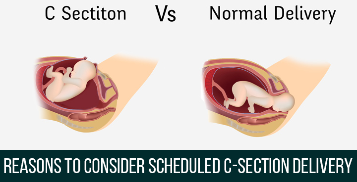 Reasons to consider SCHEDULED C-Section delivery 2018