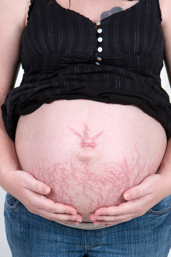 How To take away Stretch Marks when Pregnancy.