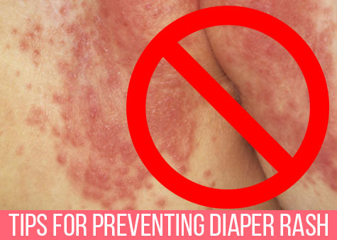 Prevent diaper rash